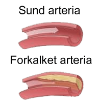 Smartfod i Vanløse kan hjælpe dig med åreforkalkning